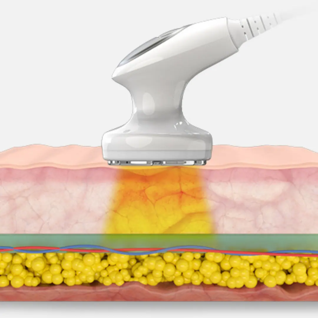 Soft Laser-Lipolaser